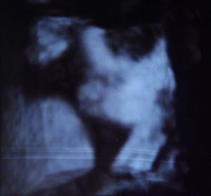 Read more about the article 32 week ultra sound